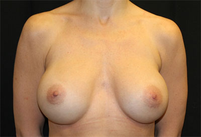 Breast Augmentation - Round Silicone Implants Before & After Patient #25484