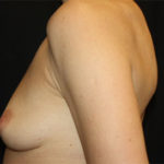 Breast Augmentation - Round Silicone Implants Before & After Patient #25484