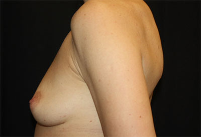 Breast Augmentation - Round Silicone Implants Before & After Patient #25484