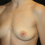 Breast Augmentation - Round Silicone Implants Before & After Patient #25484