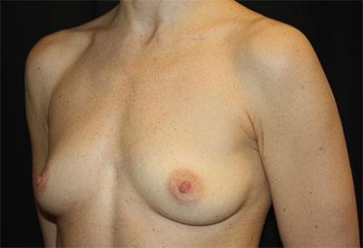 Breast Augmentation - Round Silicone Implants Before & After Patient #25484