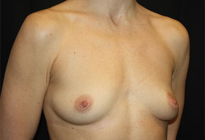 Breast Augmentation - Round Silicone Implants Before & After Patient #25484