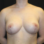 Breast Lift with Implant Before & After Patient #26678