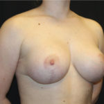 Breast Lift with Implant Before & After Patient #26678