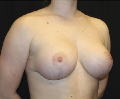 Breast Lift with Implant Before & After Patient #26678