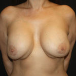 Breast Lift with Implant Before & After Patient #26685