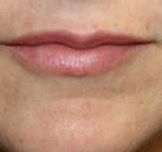 Lip Augmentation Before & After Patient #27156