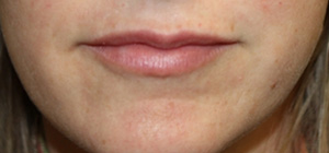 Lip Augmentation Before & After Patient #27156