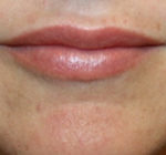 Lip Augmentation Before & After Patient #27156