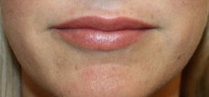 Lip Augmentation Before & After Patient #27156