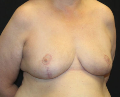 Breast Reduction Before & After Patient #27089