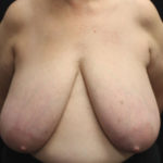 Breast Reduction Before & After Patient #27089