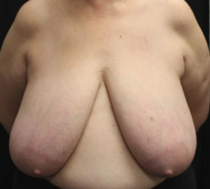 Breast Reduction Before & After Patient #27089