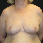 Breast Reduction Before & After Patient #27089