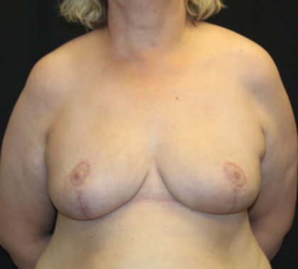 Breast Reduction Before & After Patient #27089