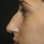 Rhinoplasty Before & After Patient #27174