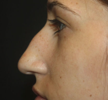 Rhinoplasty Before & After Patient #27174