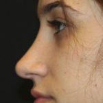 Rhinoplasty Before & After Patient #27174