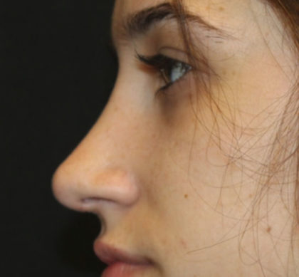 Rhinoplasty Before & After Patient #27174