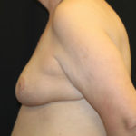 Breast Reduction Before & After Patient #27089