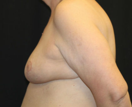 Breast Reduction Before & After Patient #27089