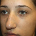 Rhinoplasty Before & After Patient #27174