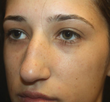 Rhinoplasty Before & After Patient #27174