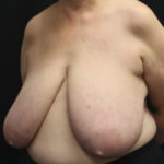 Breast Reduction Before & After Patient #27089