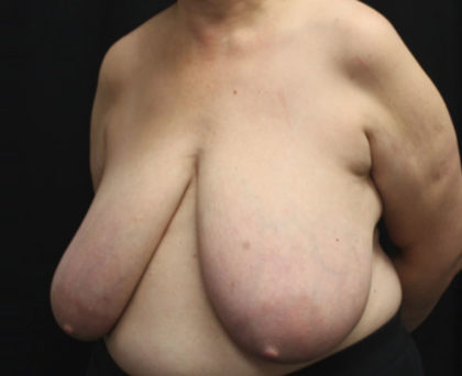 Breast Reduction Before & After Patient #27089