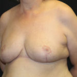 Breast Reduction Before & After Patient #27089