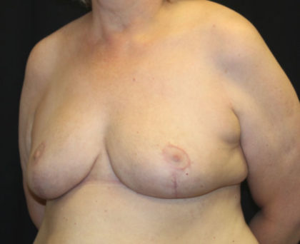 Breast Reduction Before & After Patient #27089