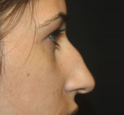 Rhinoplasty Before & After Patient #27174