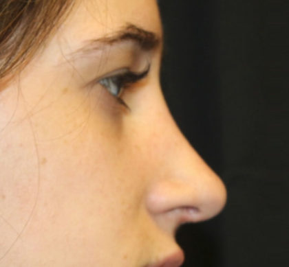 Rhinoplasty Before & After Patient #27174
