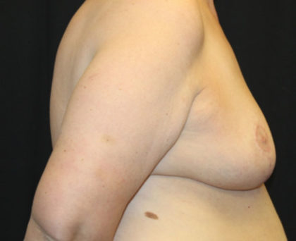 Breast Reduction Before & After Patient #27089