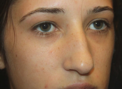 Rhinoplasty Before & After Patient #27174