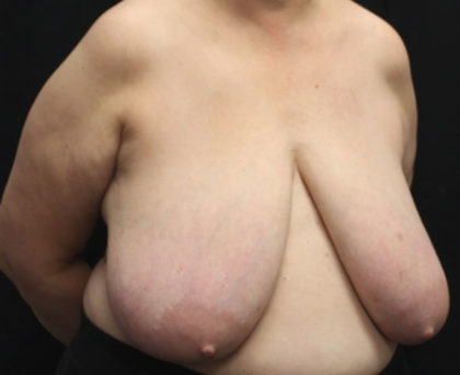 Breast Reduction Before & After Patient #27089