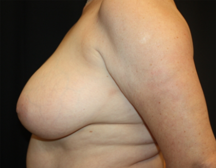 Breast Lift Before & After Patient #27216