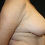 Breast Lift Before & After Patient #27216