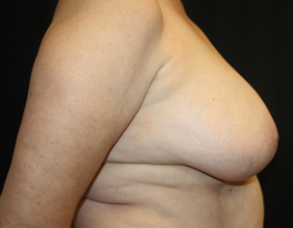 Breast Lift Before & After Patient #27216