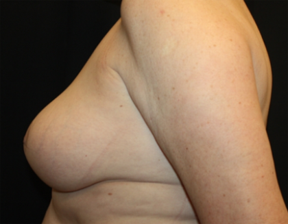 Breast Lift Before & After Patient #27216