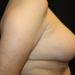 Breast Lift Before & After Patient #27216