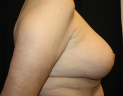 Breast Lift Before & After Patient #27216