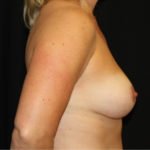 Breast Lift Before & After Patient #27227