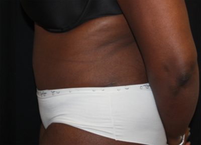 Tummy Tuck Before & After Patient #27144