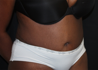 Tummy Tuck Before & After Patient #27144