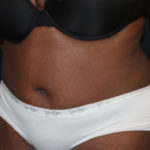 Tummy Tuck Before & After Patient #27144