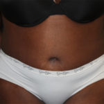 Tummy Tuck Before & After Patient #27144