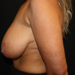 Breast Lift Before & After Patient #27249