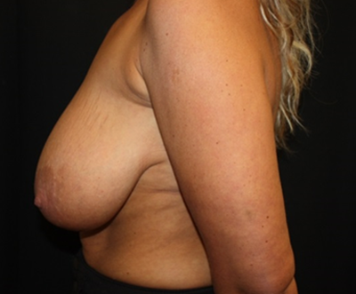 Breast Lift Before & After Patient #27249