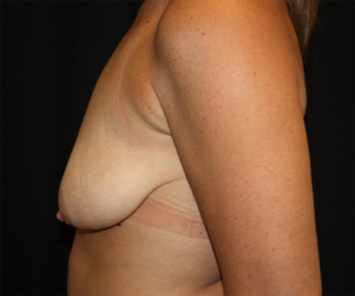 Breast Lift Before & After Patient #27256